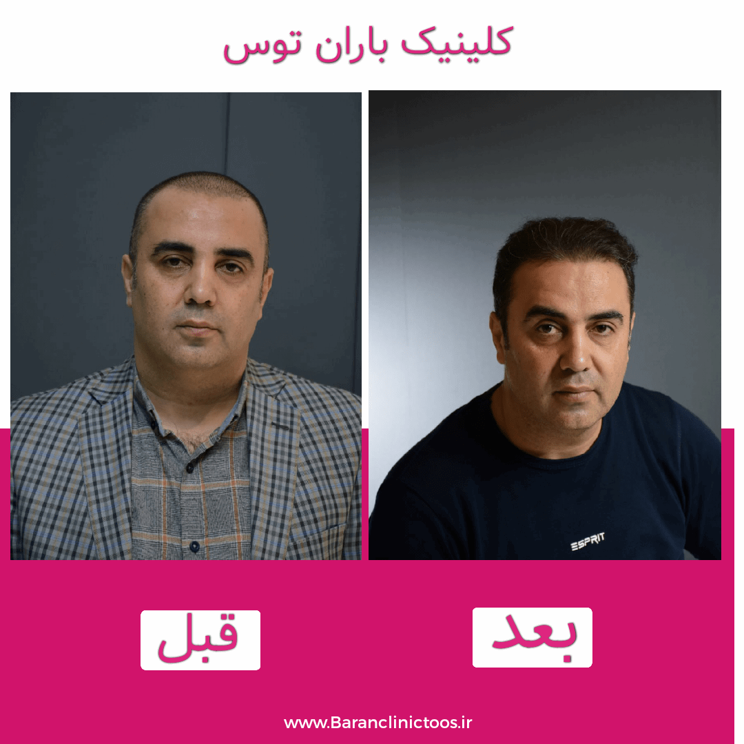 قبل و بعد کاشت مو